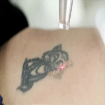 Laser Tattoo Removal Brickell
